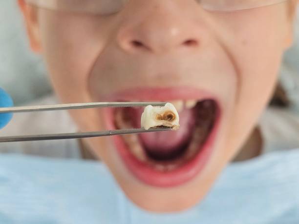 Best Broken or Chipped Tooth Repair in Brooklet, GA